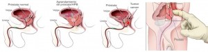 Hiperplasia benigna de la prostata1