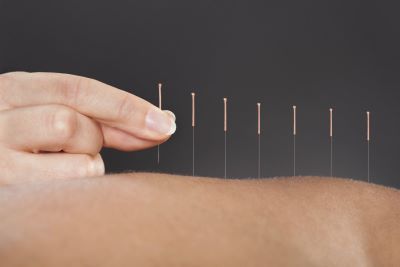 Mano insertando una aguja de acupuntura verticalmente en la espalda de un paciente, alineada con otras agujas en fila simétrica.